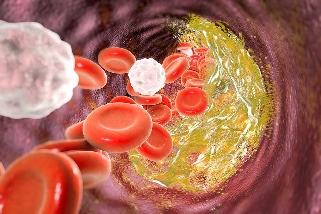 Atherosclerosis treatment in Germany Atherosclerosis treatment in Germany