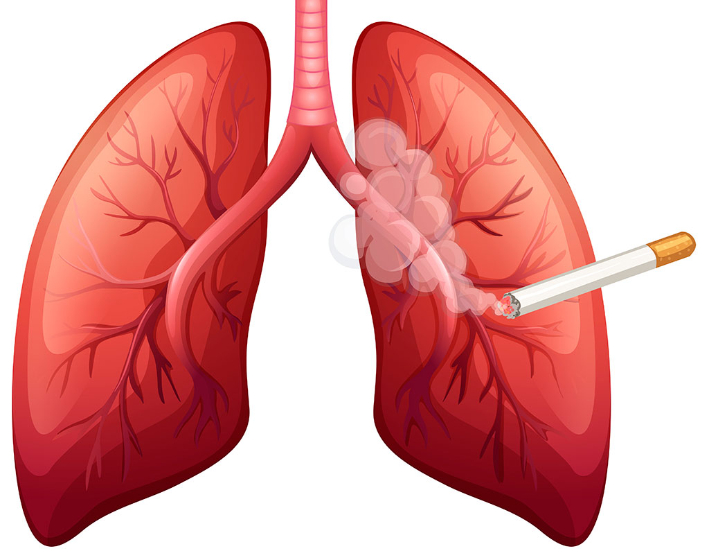 Causes Of Lung Cancer Booking Health