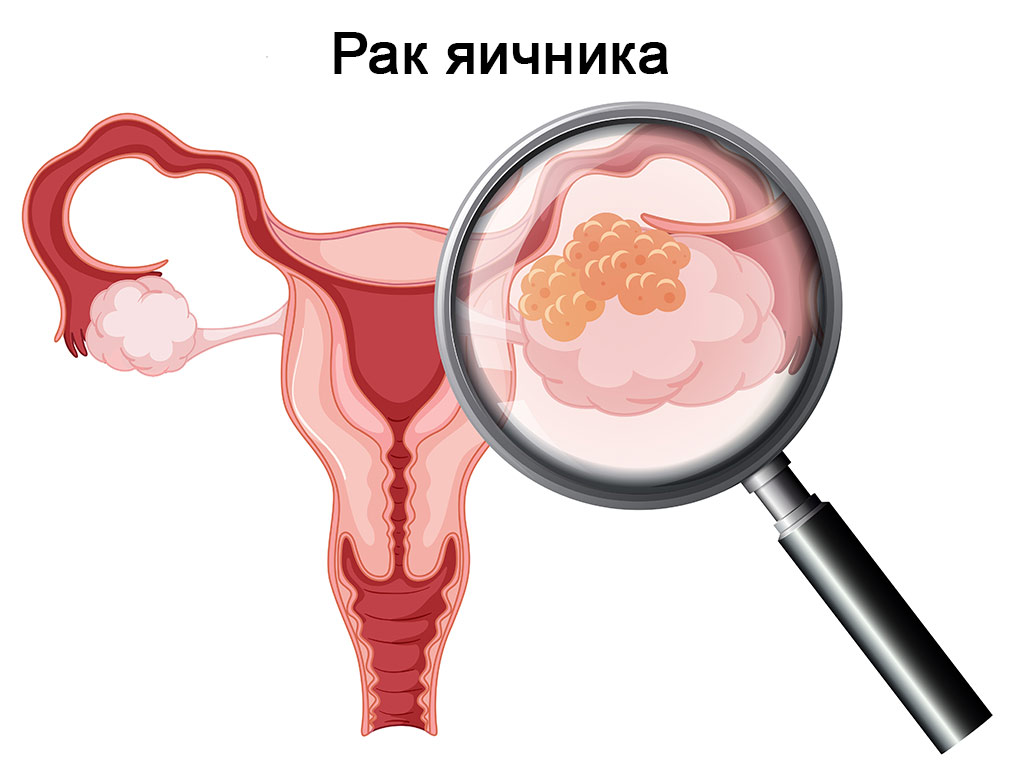 Рак яичника: методы диагностики и лечения — «IPnews»