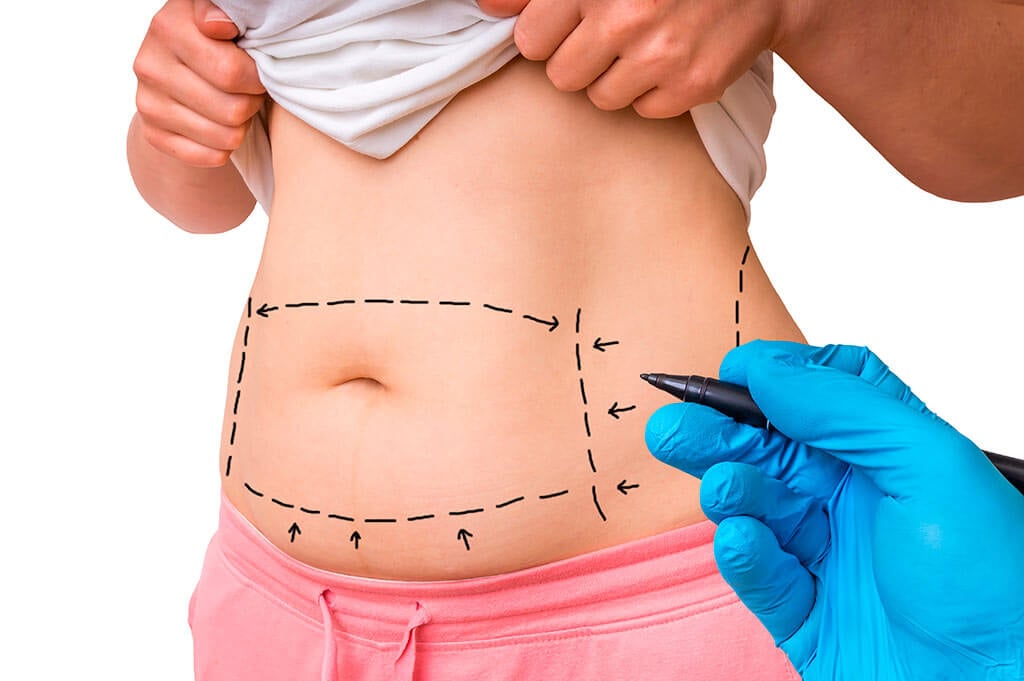 Lipoabdominoplasty: Advanced Body Contouring – Dr John Burns