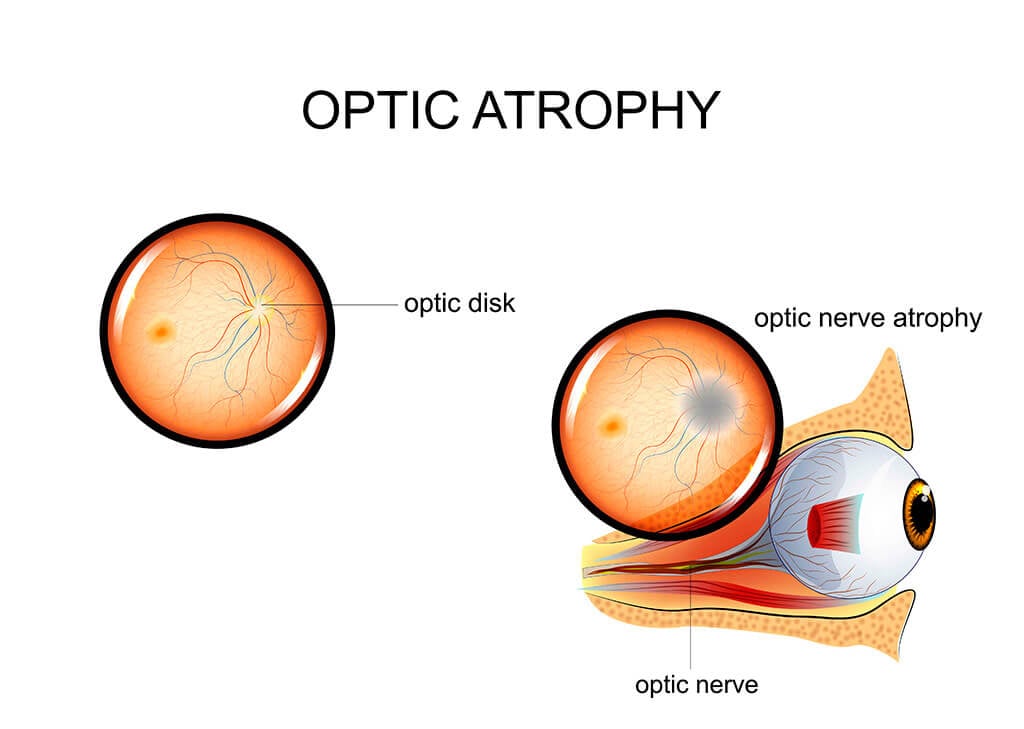 Optic Nerve Atrophy Vs Normal