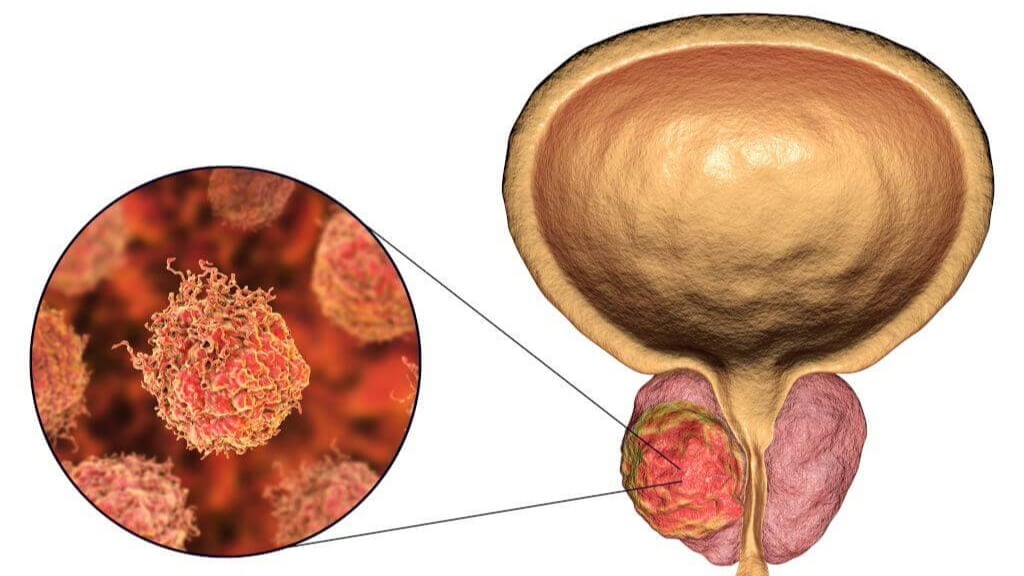 Prostate cancer