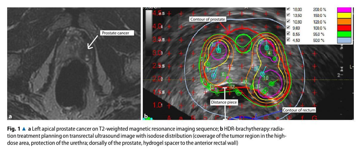 Left apical prostate cancer