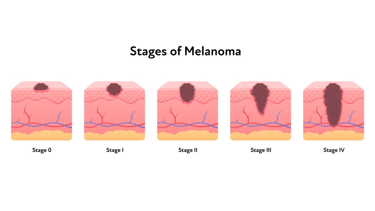 Stages of melanoma