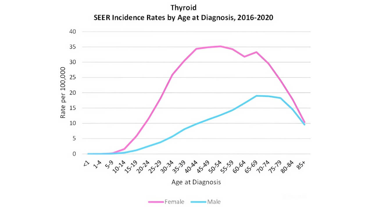 Thyroid cancer incidence rate by age at diagnosis among sexes, 2016–2020. Adapted from SEER (2024)