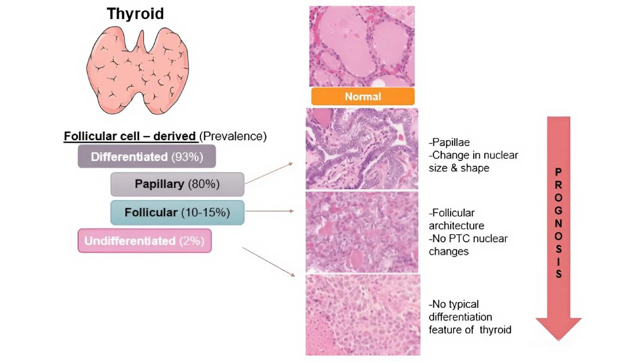 Follicular cell-derived thyroid cancers