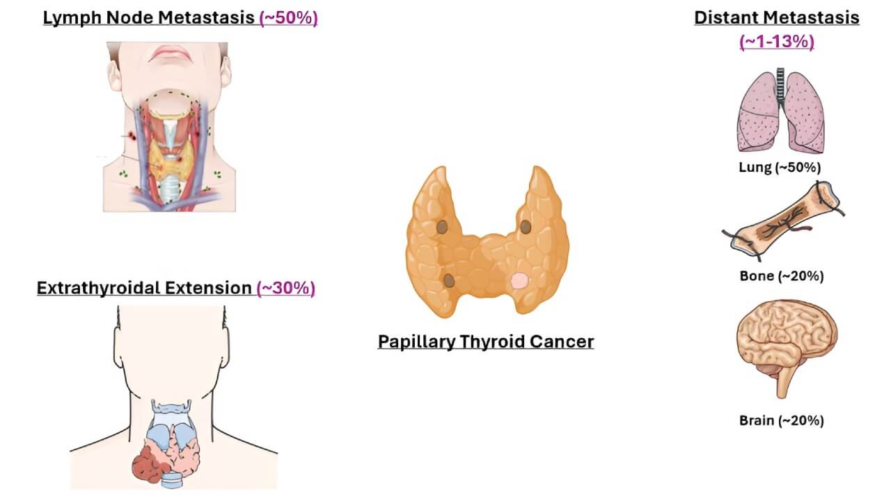 Clinical presentation of Papillary Thyroid Cancer