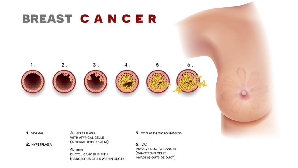 Breast Cancer