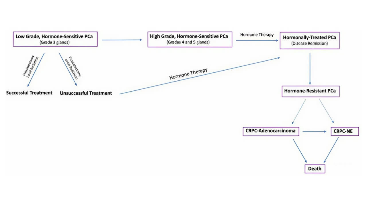 The Progression of Prostate Cancer