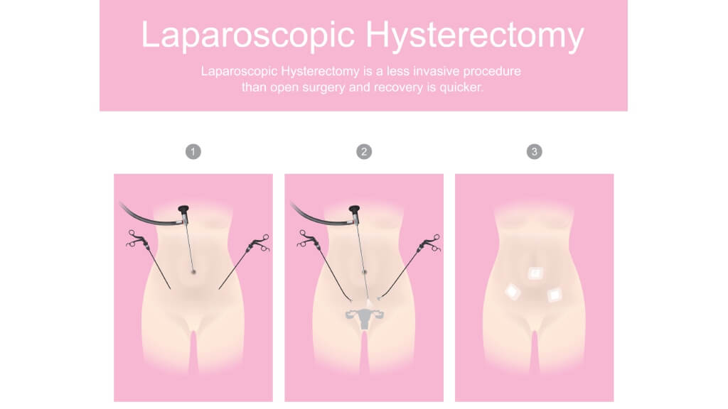 Laparoscopic hysterectomy