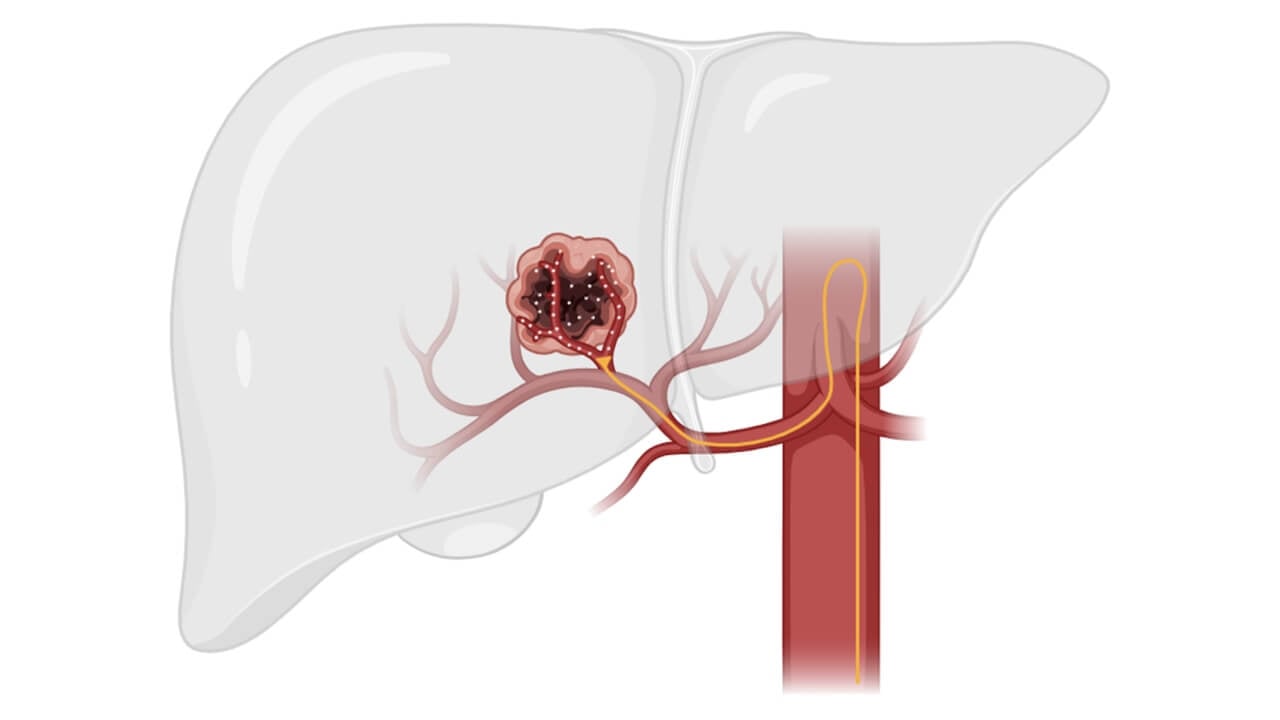 The General Technique Used in TACE Therapy