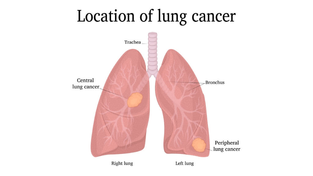 Location of the two types of lung cancer - the central and peripheral
