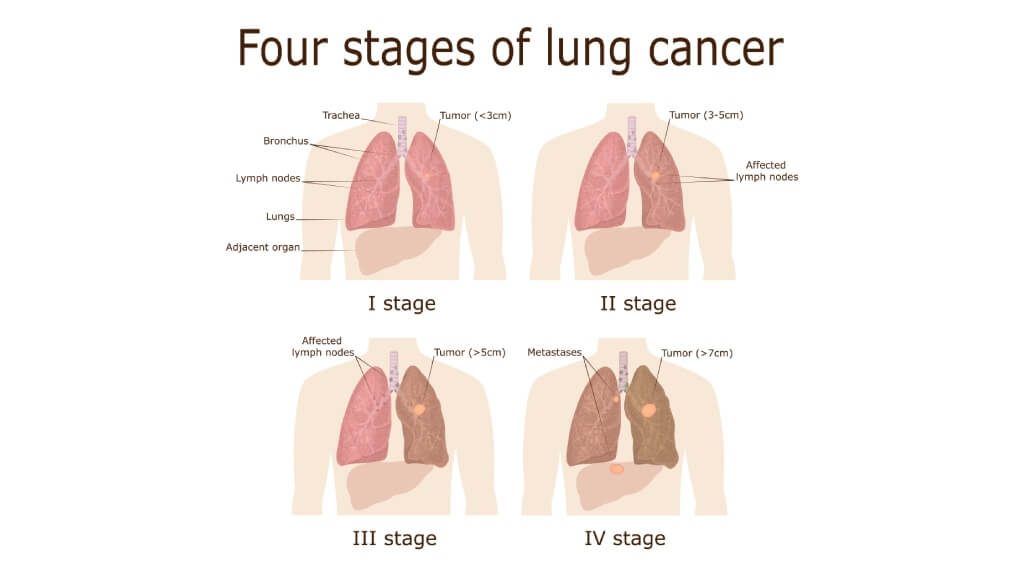 Illustration of the four stages of oncological disease - lung cancer