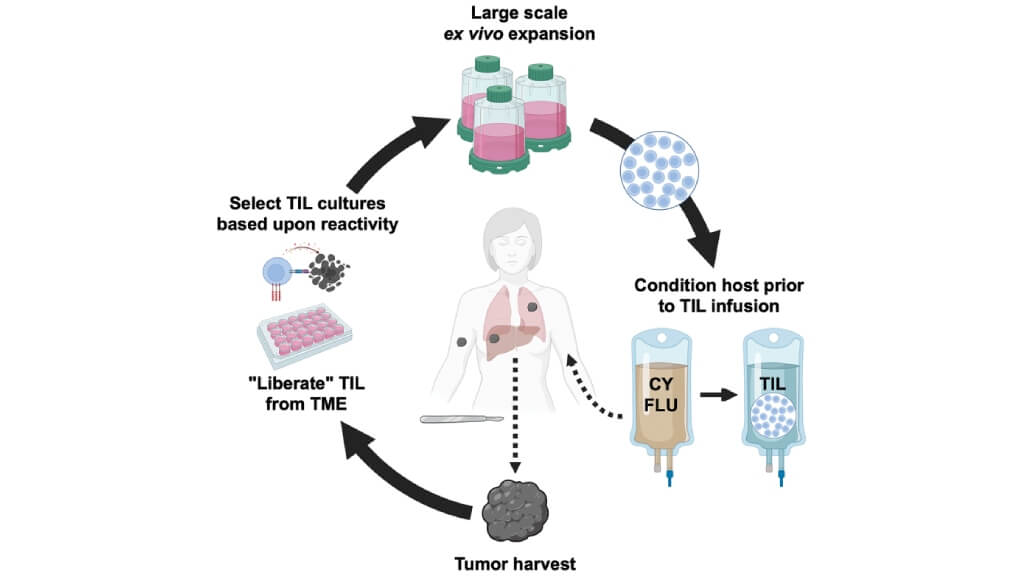 Types of immunotherapy for melanoma Key steps for adoptive cell therapy with tumor-infiltrating lymphocytes