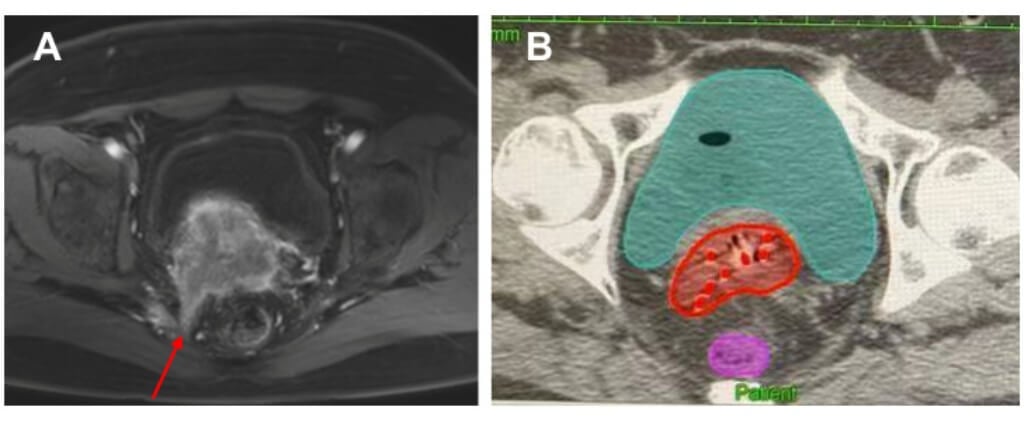 A cervix cancer patient with sacrococcygeal ligament invasion who was performed free handed implantation brachytherapy