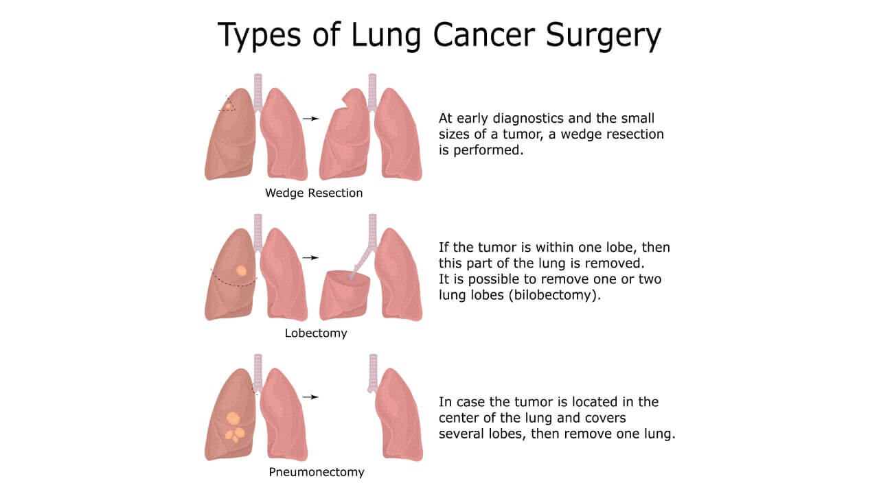 Illustration of three types of lung cancer surgery