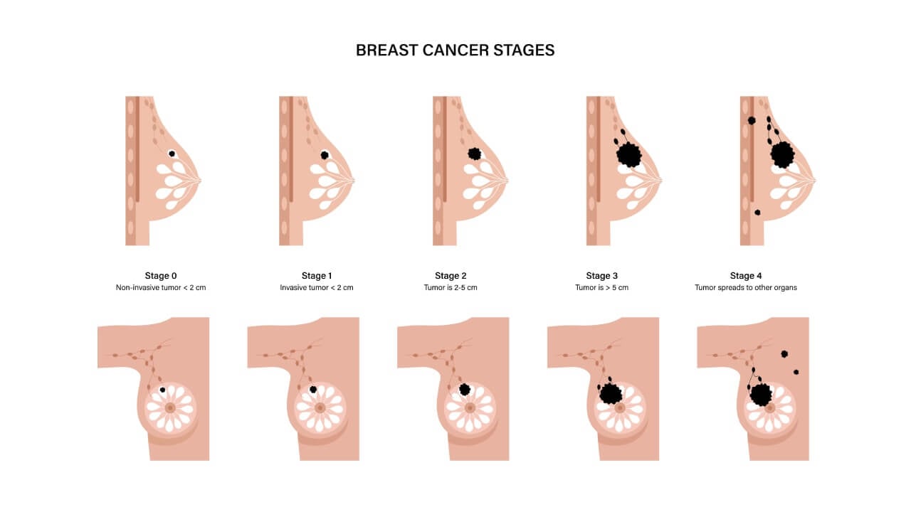 Breast cancer stages