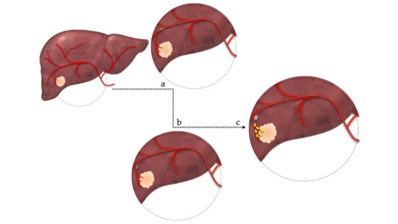Balloon-occluded transarterial chemoembolization