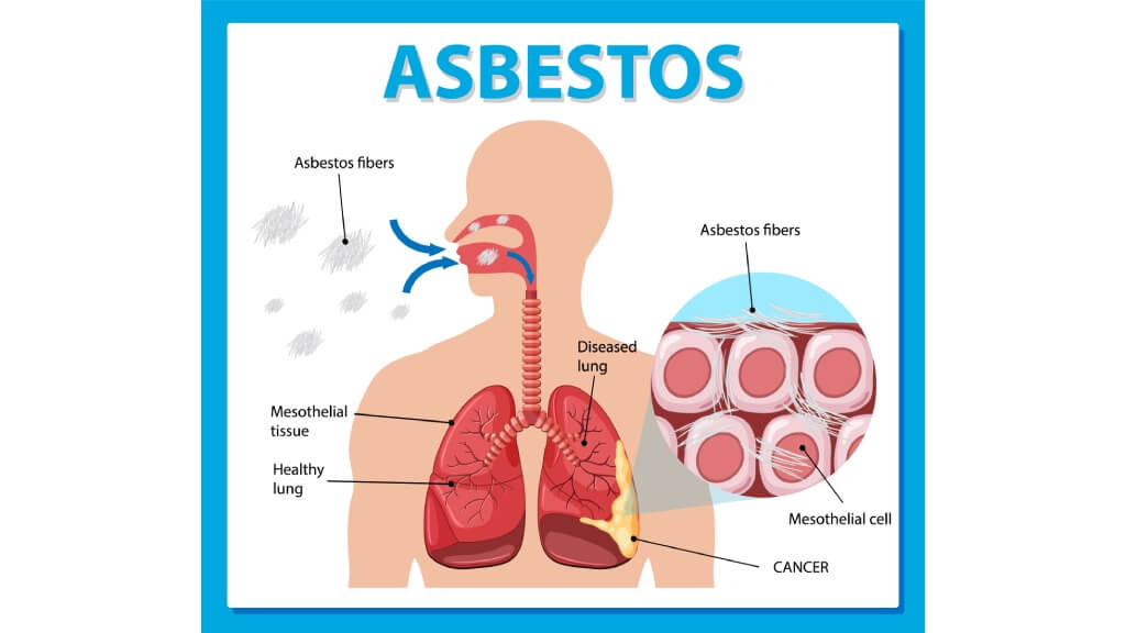 Asbestosis
