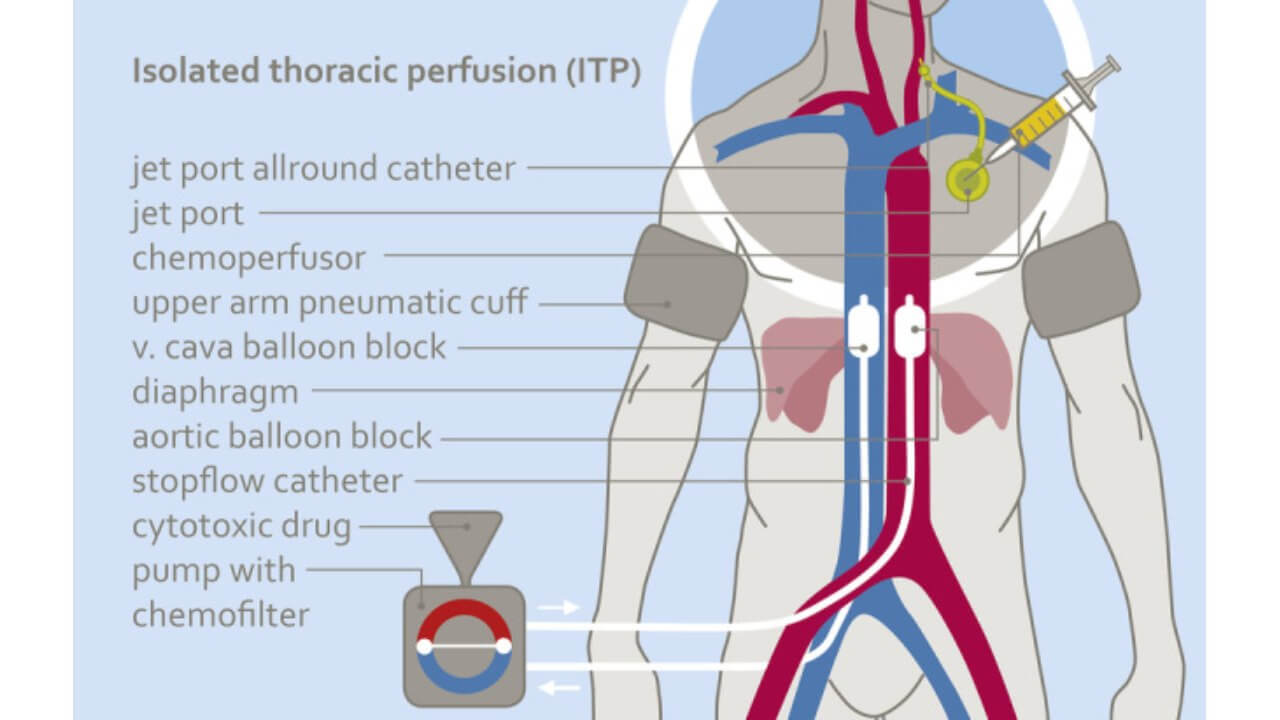 مخطط تروية صدرية معزولة مقترنة مع التسريب قصير المدة داخل الشريان عبر قسطرة Jetport all-around