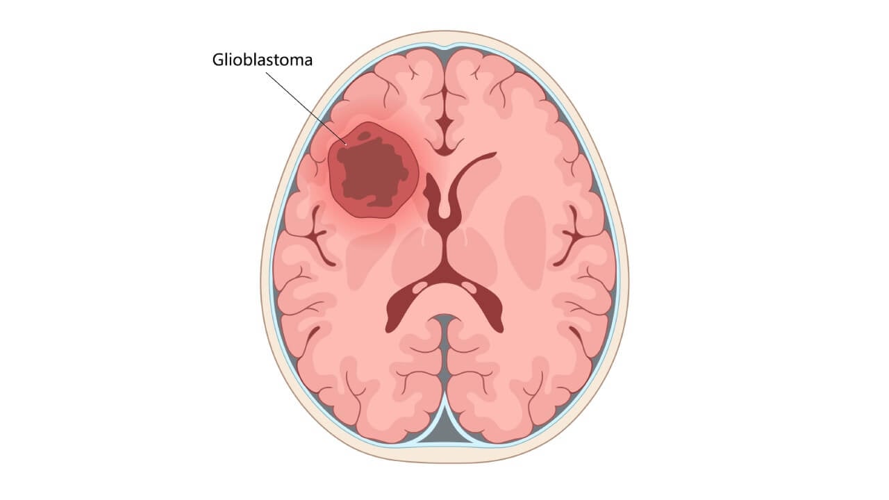 Glioblastoma (GBM)