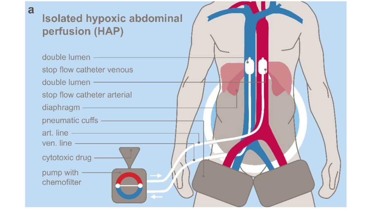 Schematic principle of isolated hypoxic abdominal perfusion