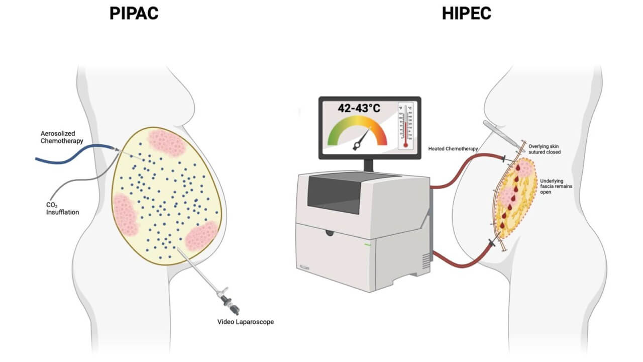 Schematic depiction of PIPAC (left) versus HIPEC (right)