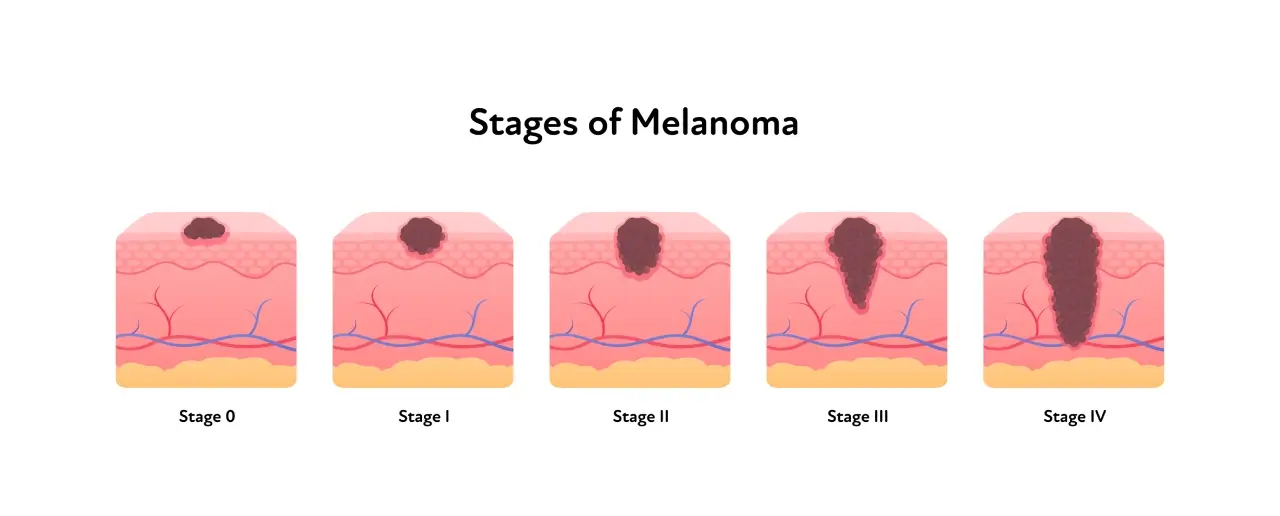 Stages of melanoma