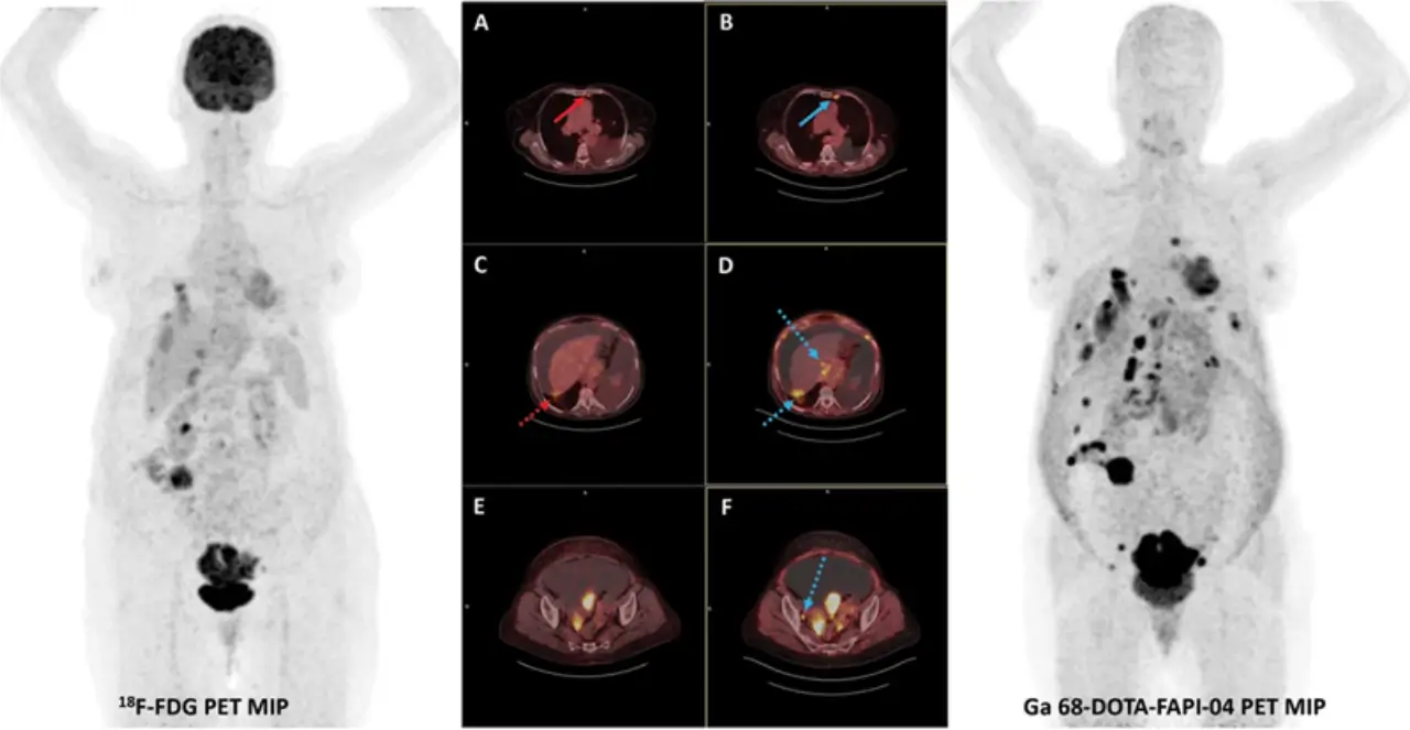 مُقارنة بين التصوير باستخدام FDG-PET/CT والتصوير باستخدام FAPI-PET/CT لدى امرأة مصابة بسرطان القولون والمستقيم النقيلي